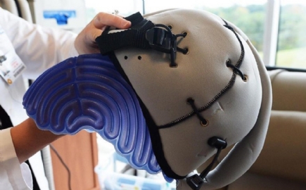 CARMAGNOLA - Diventa operativo il casco refrigerante per curare l'alopecia in chemioterapia